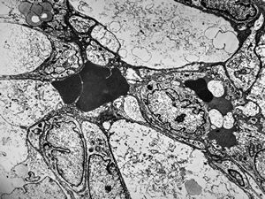 F,49y. | hemangioblastoma - brain F,49y. | hemangioblastoma - brain